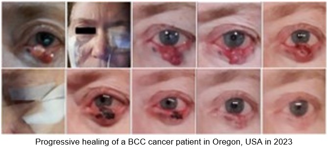 Progressive healing of Basal Cell Carcinoma