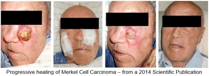 Progressive healing of Merkel Cell Carcinoma