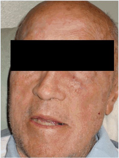 Merkel cell carcinoma successfully treated - 2nd Patient