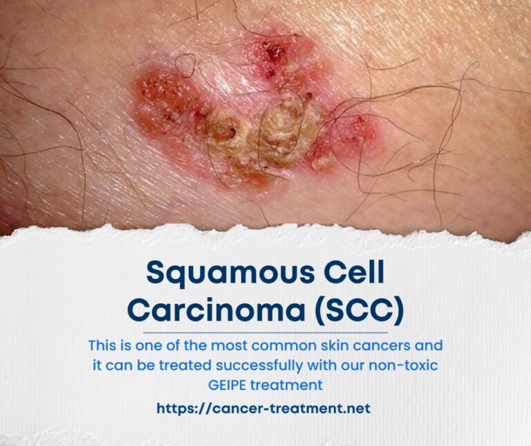 Nature of Squamous Cell Carcinoma and its best treatment