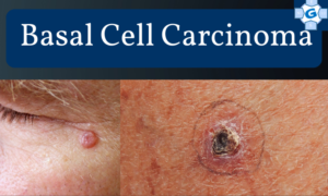 Preventing Basal Cell Carcinoma: Lifestyle Changes and Risk Reduction