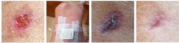 Healing of a Melanoma patient by GEIPE therapy